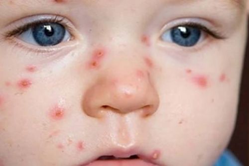 Foto: Mezi předškoláky v Plzni řádí plané neštovice