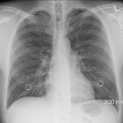 Zaměstnanci Borgersu v Hrádku musí na rentgen, jeden z cizinců má tuberkulózu 